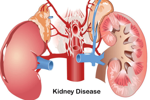 kidney disease - NBC SVG